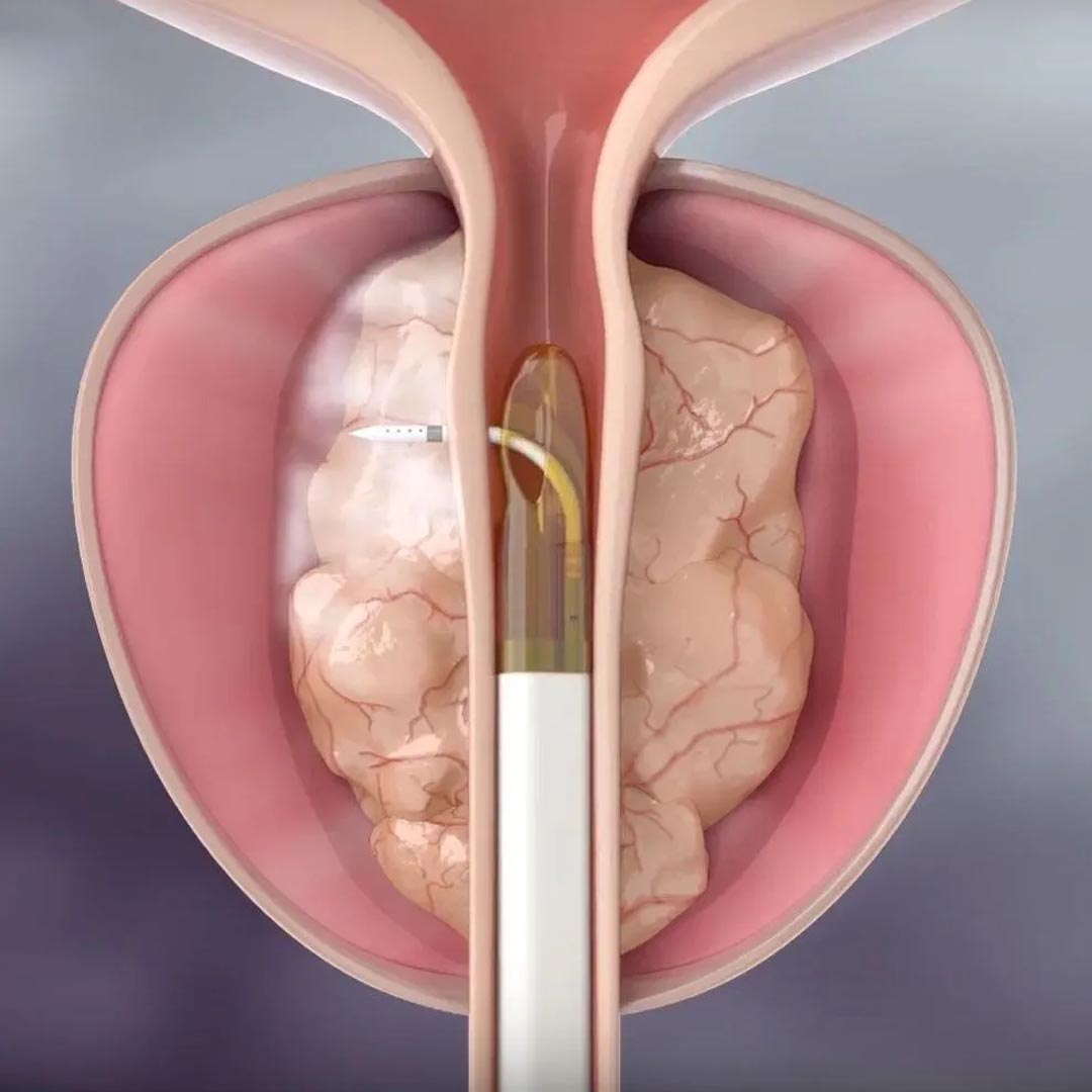 Particolare Sonda Rezum - Procedura